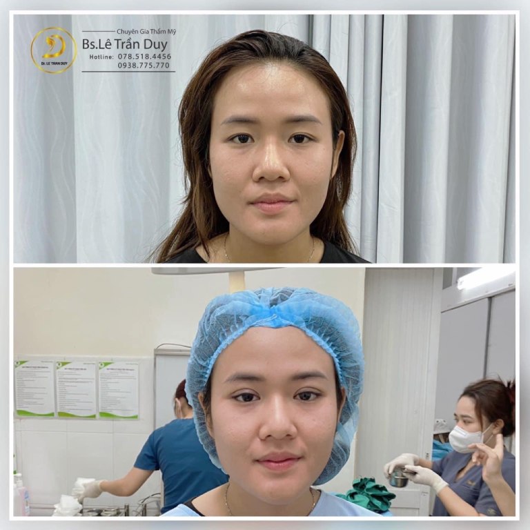 Top 10 địa chỉ nhấn mí mắt uy tín ở TPHCM