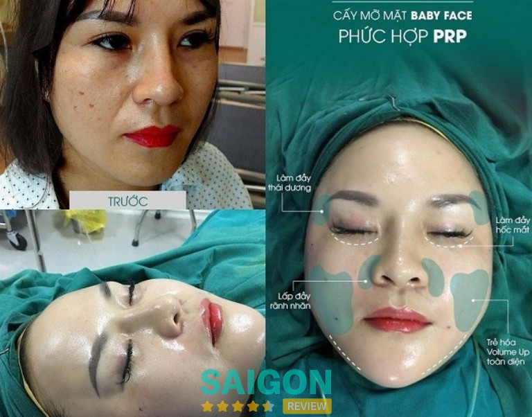 Top 5 địa chỉ cấy mỡ mặt Babie Face uy tín ở TPHCM